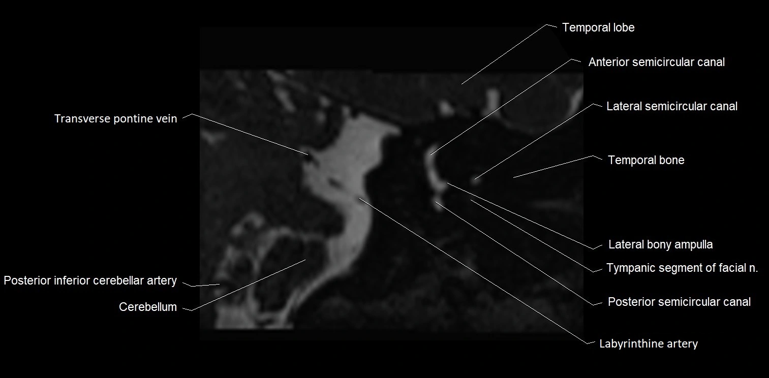 MRI Internal auditory meatus (IAM) coronal cross sectional labelled anatomy image 24.webp